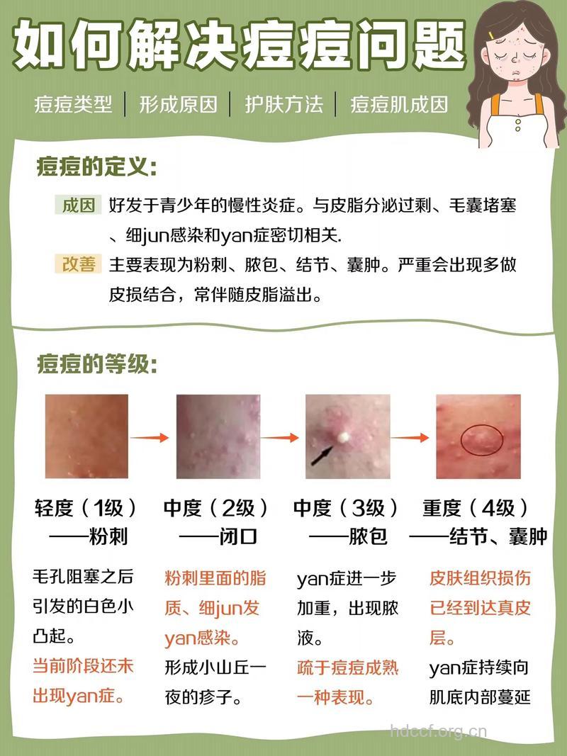 长了痤疮痘该怎么办