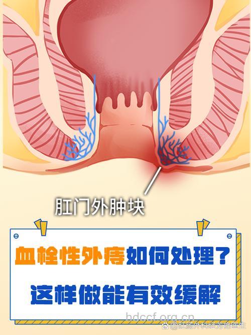成人为何更易发血栓性外痔