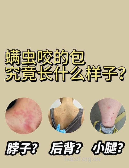 怎么分辨螨性皮炎