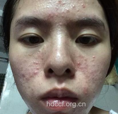 十种生活习惯招致暗疮