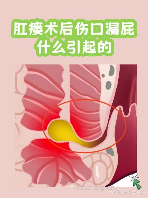 肛瘘患者术后伤口难愈合是什么原因