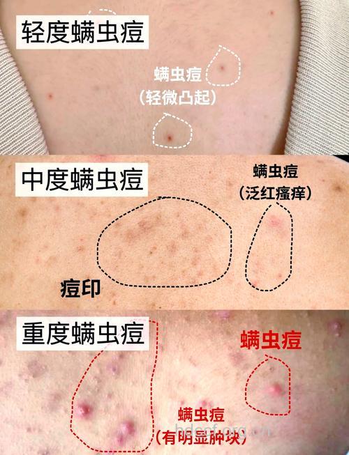 蠕形螨易致痤疮