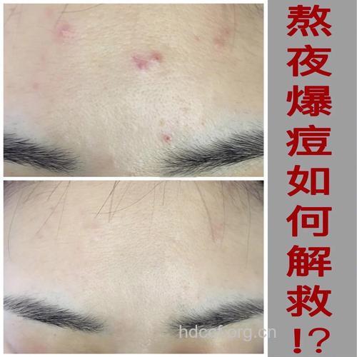 吃宵夜容易诱发痘痘