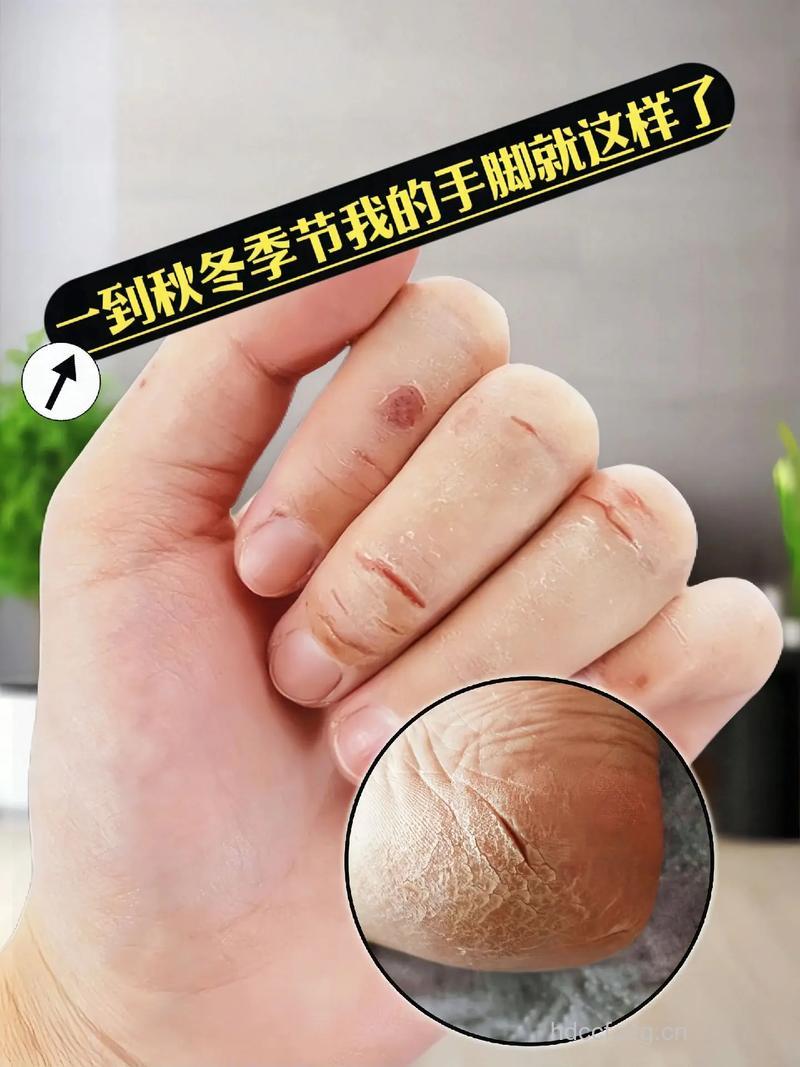 冬季手脚干燥脱皮怎么办