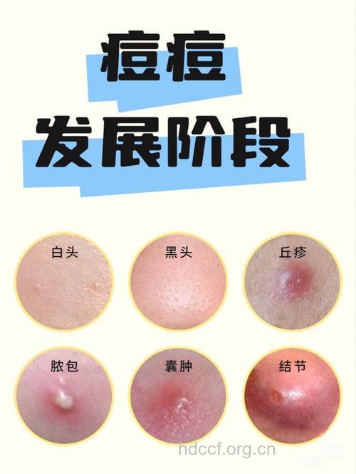 痘痘恶化的元凶