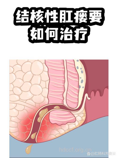 什么是结核肛瘘