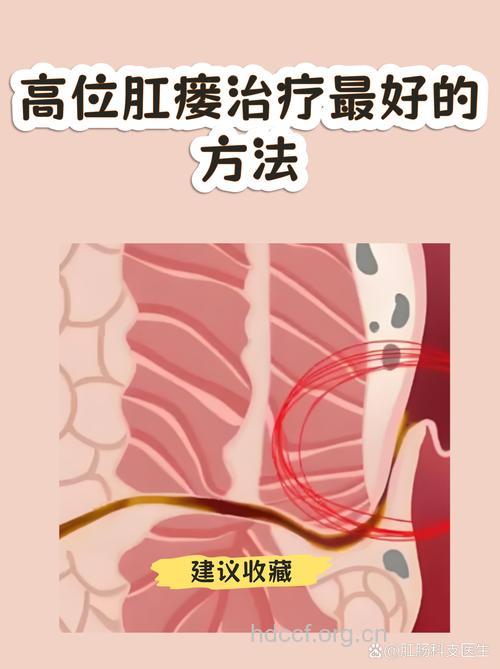 高位肛瘘是怎么形成的