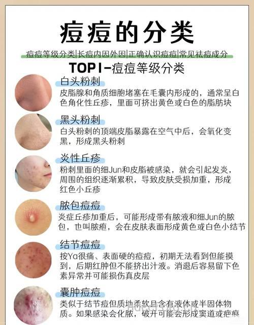 痤疮为什么会反复发作