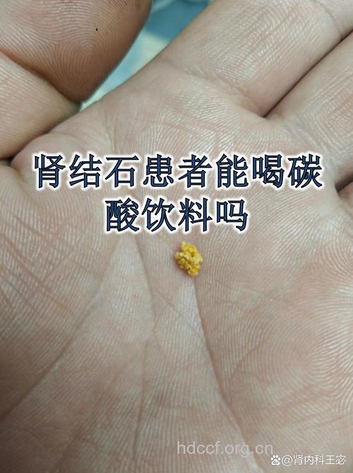 饮料是肾结石的凶手