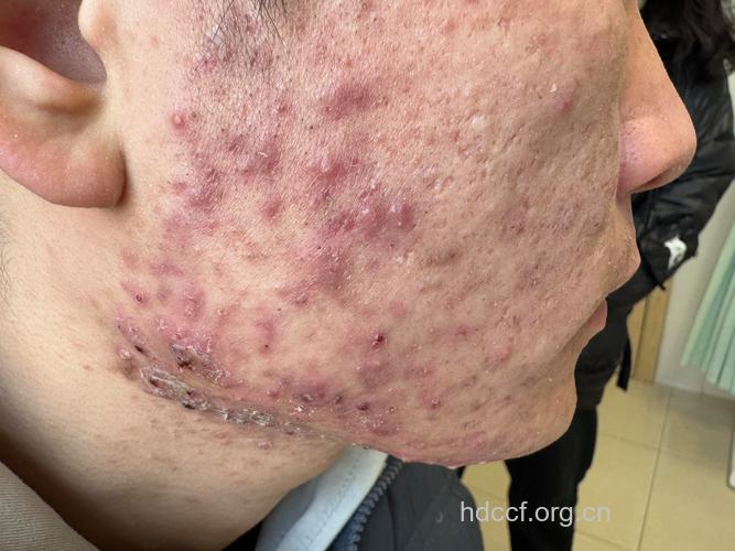 痤疮有哪些常见的症状表现