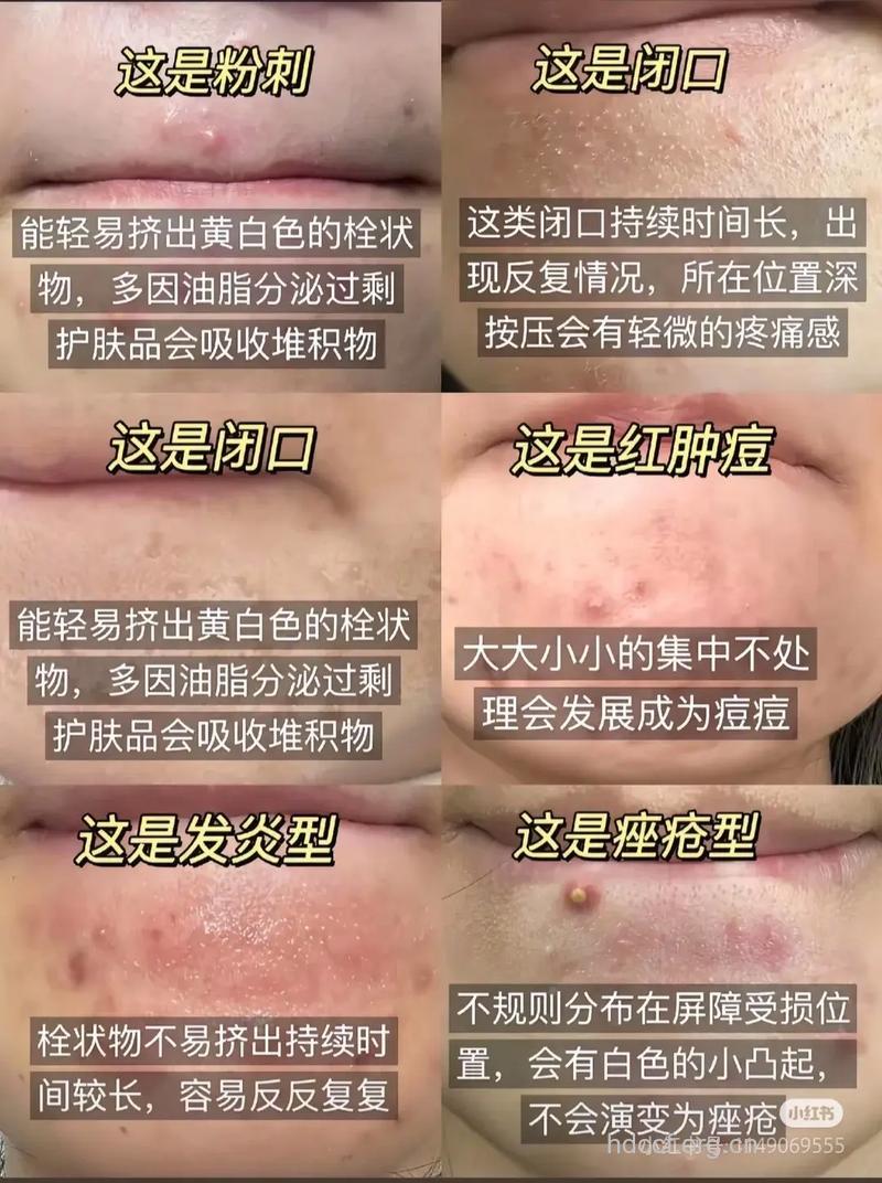 为什么会长闭合性粉刺