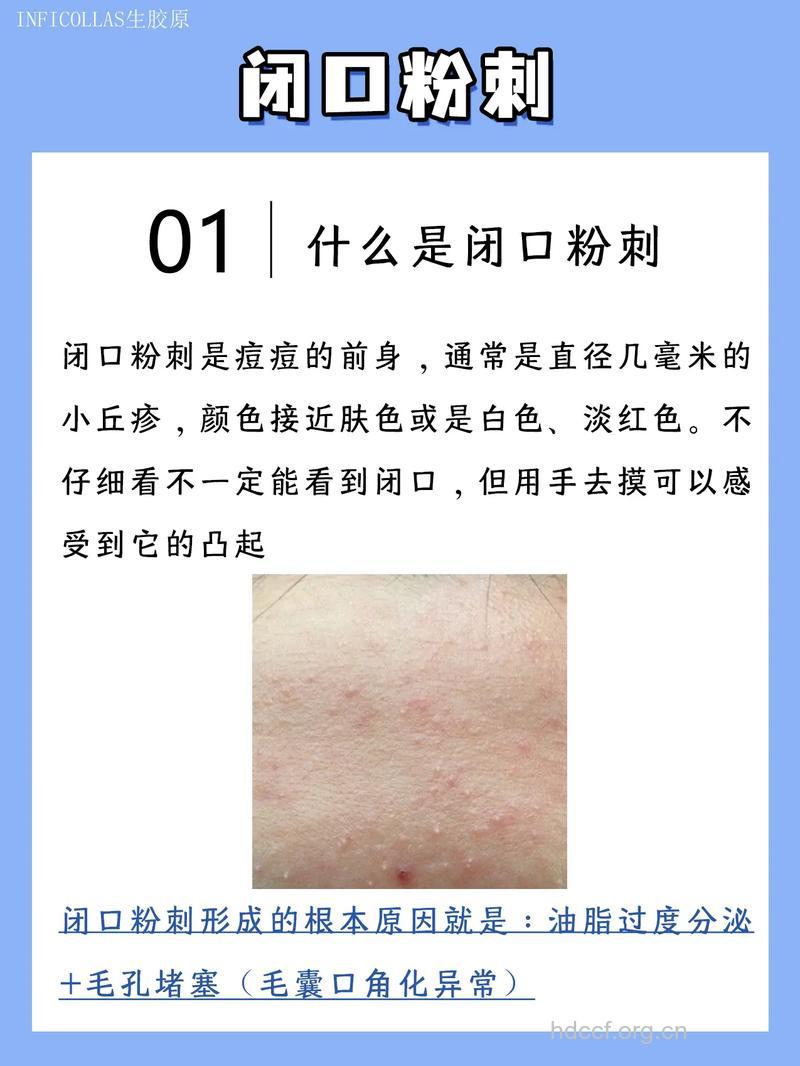 粉刺四个错误治疗方法