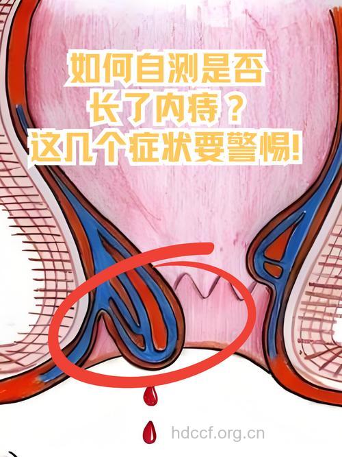 常见的内痔的症状