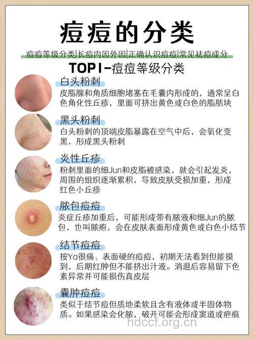 痤疮的类型有哪几种?
