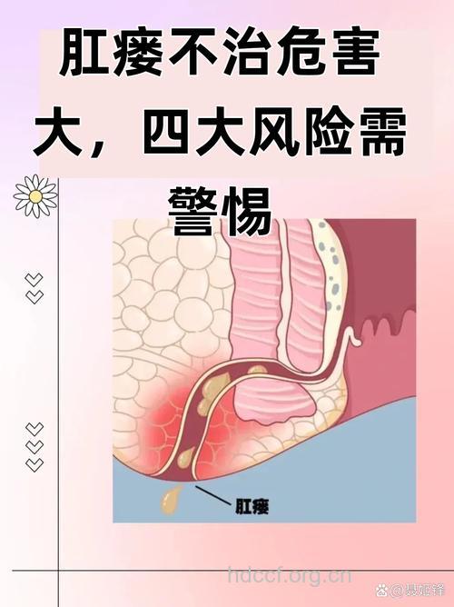 食者见真章——肛瘘