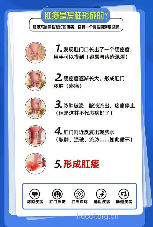 中医如何治疗肛瘘?