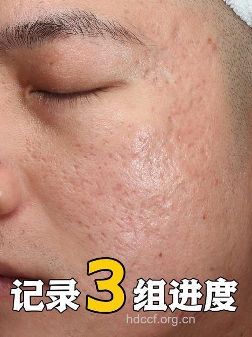 土豆小葱能去除青春痘疤痕