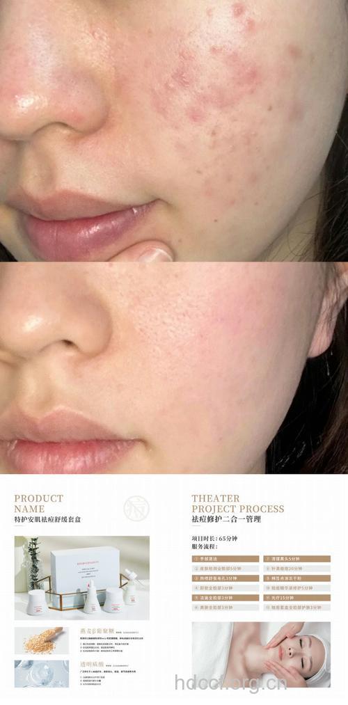 没有疤痕,才算战“痘”胜利