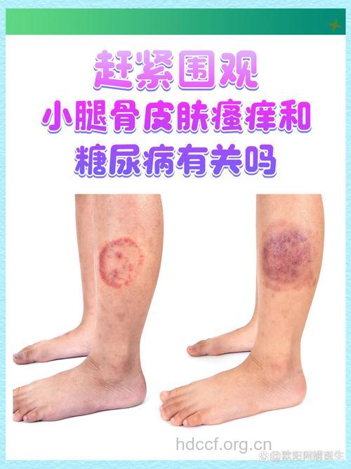 皮肤瘙痒也可能是糖尿病惹的祸