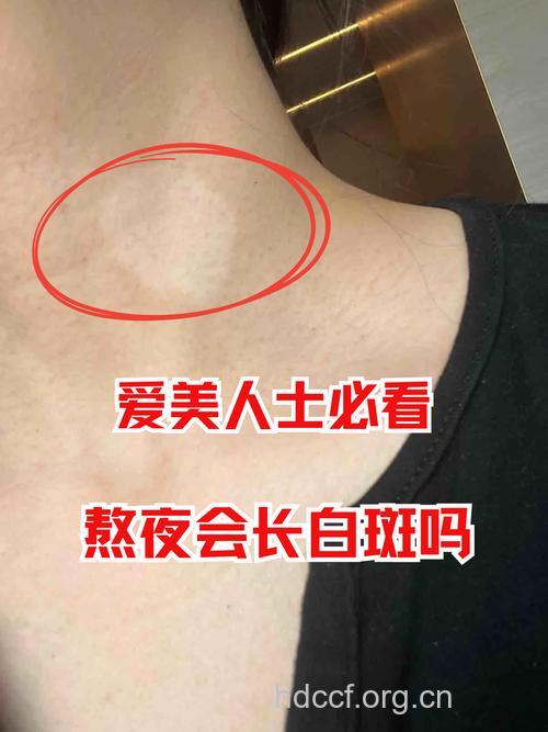 熬夜及过度劳累等会导致白癜风