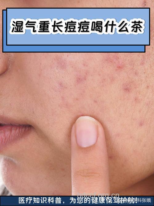 中医：湿气重更容易长痘