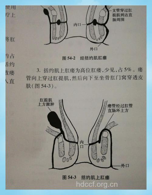 必知的基本肛瘘检查法
