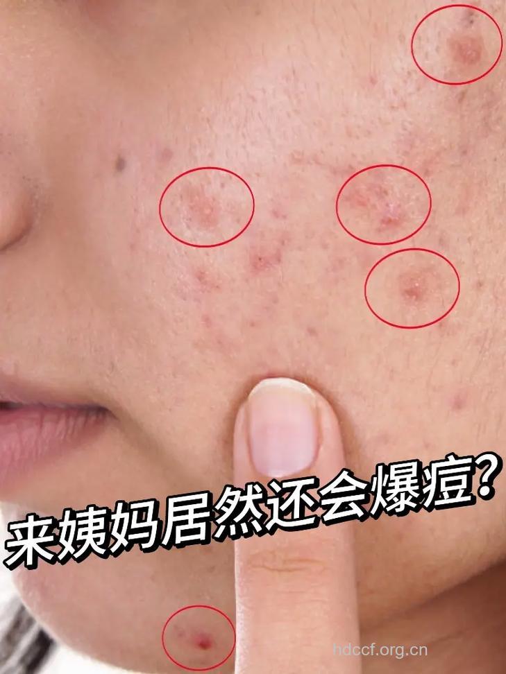 女人经期乱挤痘痘易致细菌感染