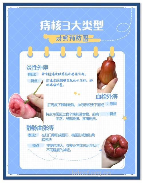 去“痔” 还你美丽健康