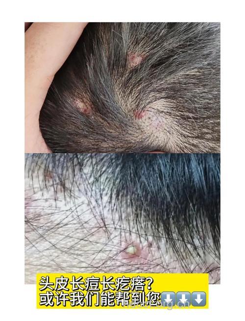 头上也会长“痘痘”？