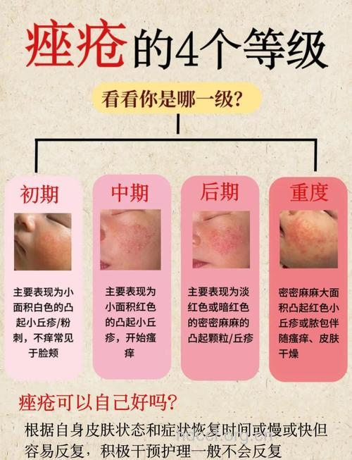 痤疮对皮肤的损害程度全解