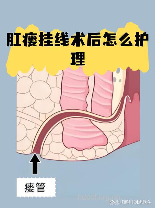 肛瘘术后护理影响手术效果