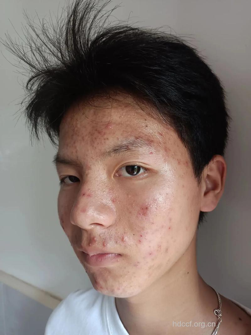 什么人爱得青春痘？