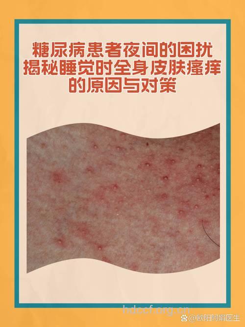 糖尿病患者为何皮肤瘙痒？