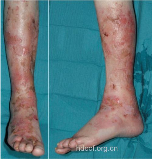 糖尿病有哪些特有皮肤表现