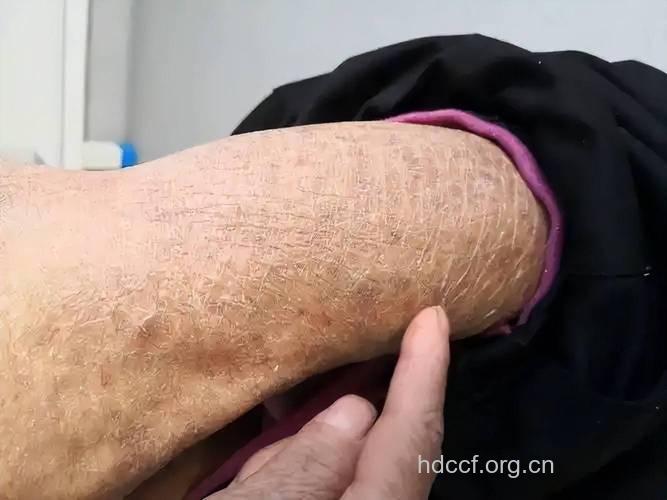 糖尿病患者的皮肤损害