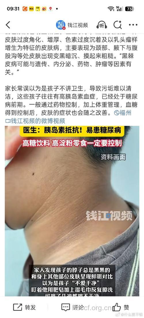 肥胖儿黑棘皮病和糖尿病相关
