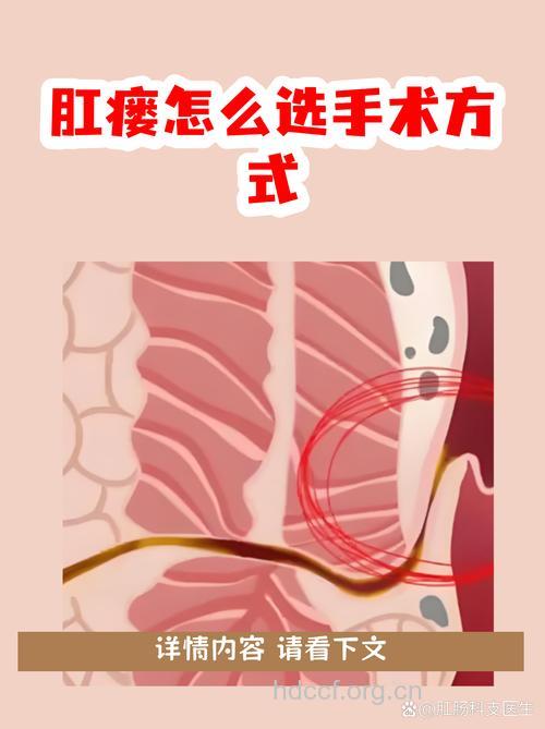 选择正确的肛瘘手术方式