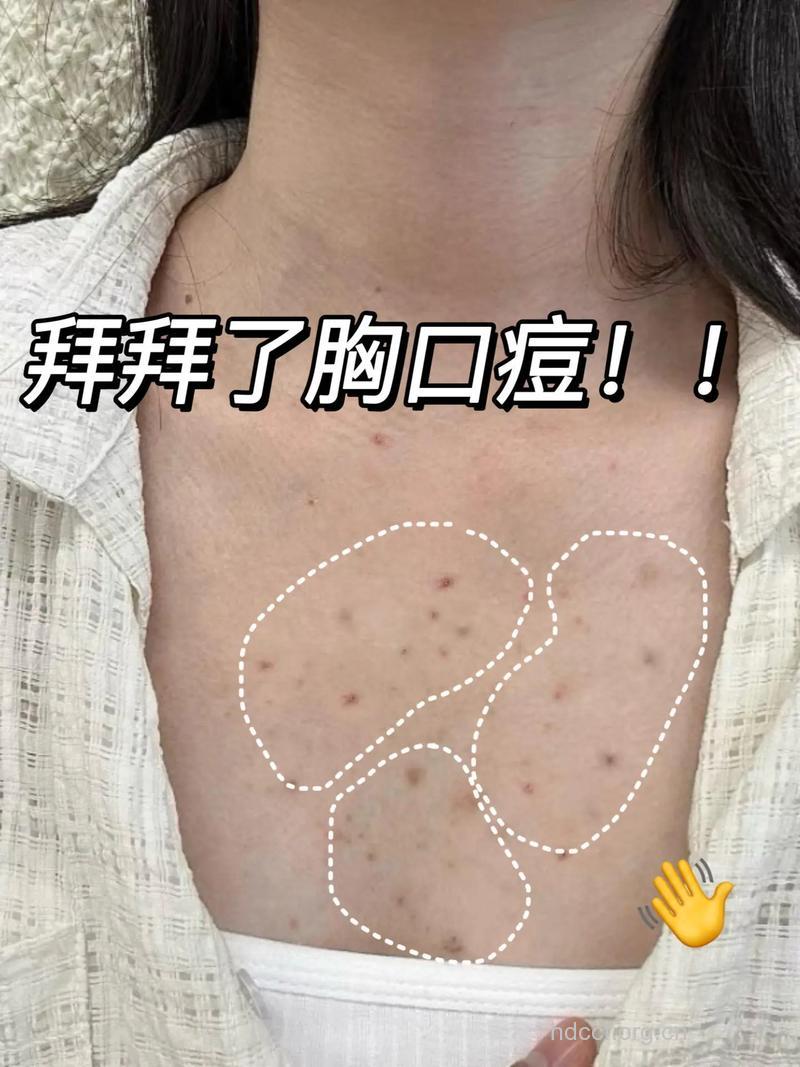 乳制品 痘痘患者的心头痛