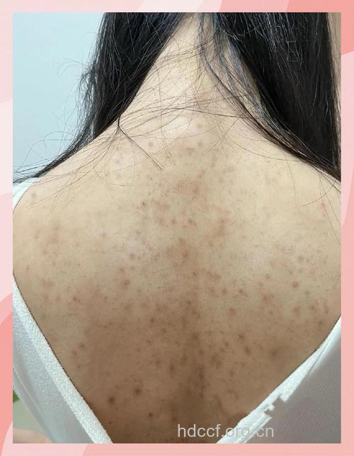 茶树精油治疗背部痘痘