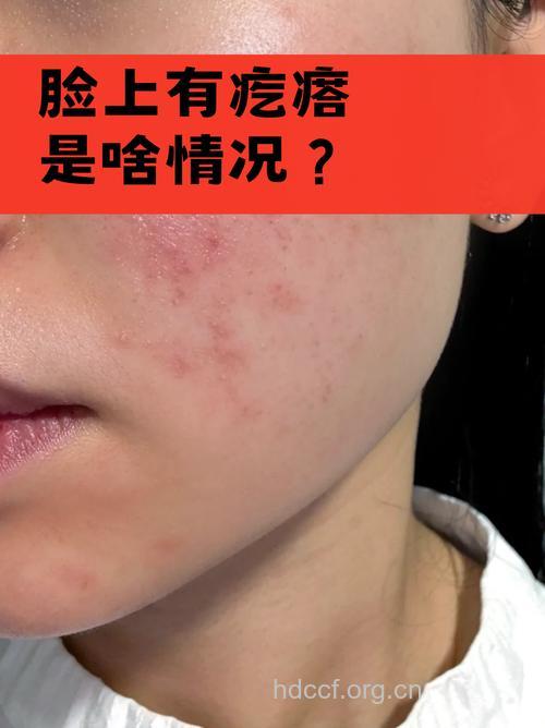 抗生素化妆品引发皮炎