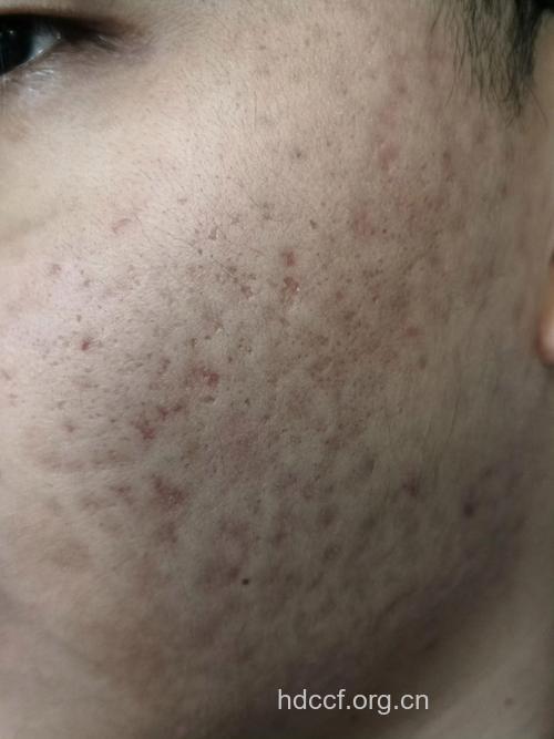 寻常型痤疮常遗留瘢痕