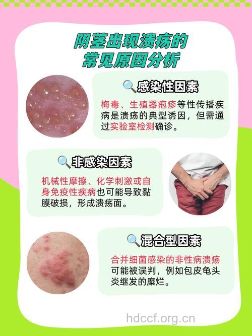 男性暗疮的预防及治疗