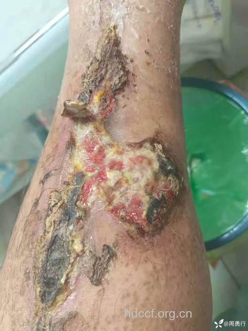 糖友做创伤性检查是不合理