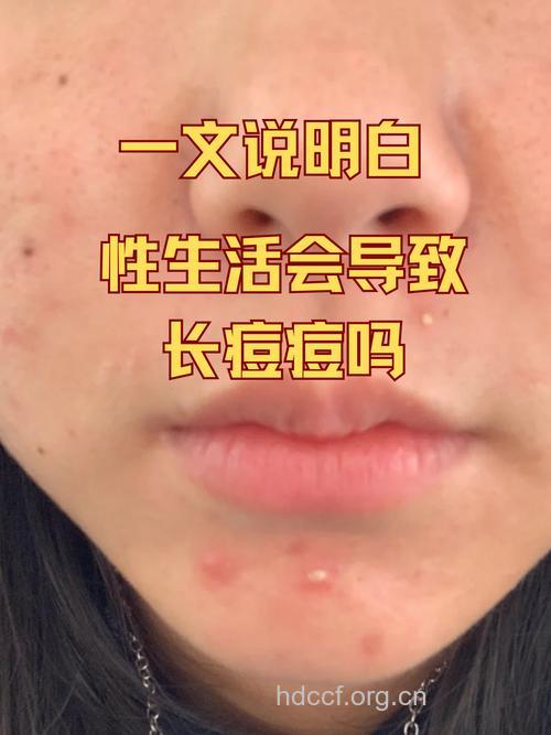 爱美MM早日和粉刺说拜拜!