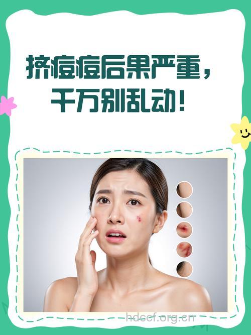 赶走青春痘后遗症 MM不再烦恼！