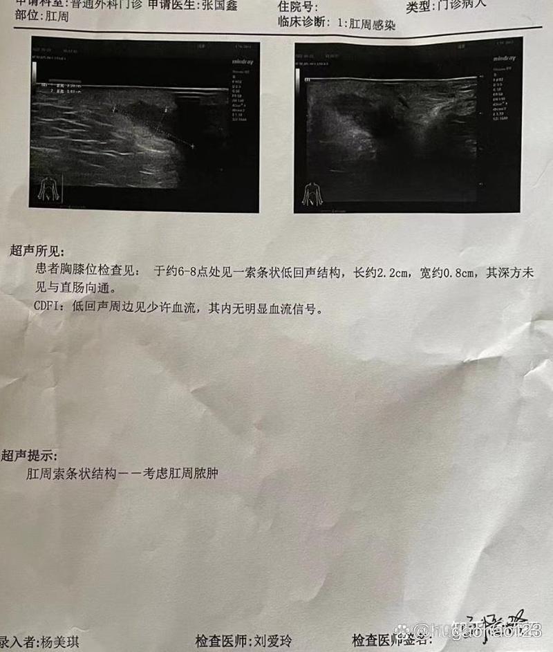 超声诊断肛瘘的价值