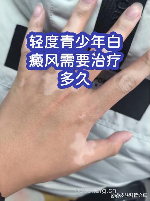 白癜风的初期要治疗多久