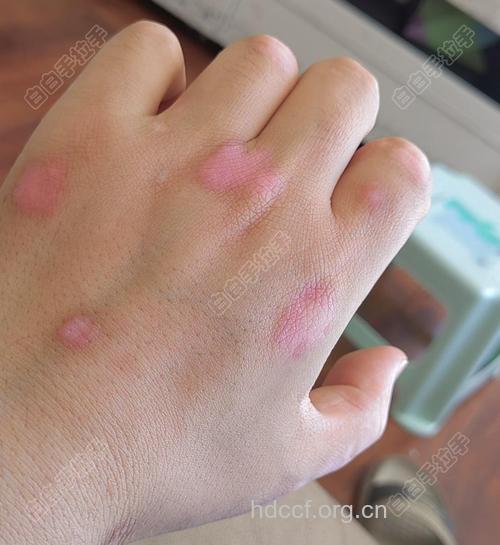 皮肤过敏严重可能诱发白癜风