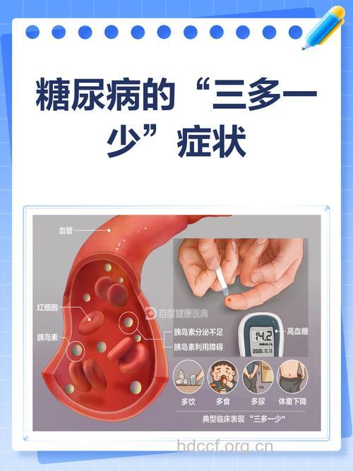 糖尿病症状的三多一少