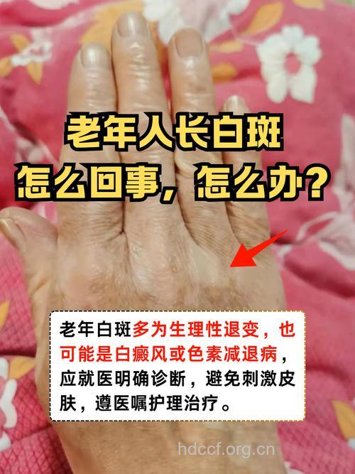 老年人为什么会患白癜风